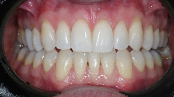 After - The Beresford Dental Clinic